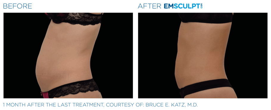 emsculpt-neo-bauch-dr-narwan-duesseldorf.png  