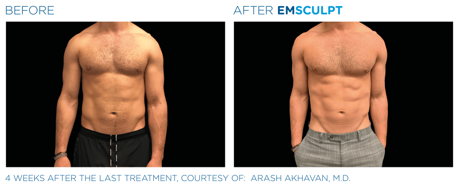 emsculpt-neo-bauch-mann-dr-narwan-duesseldorf.png  